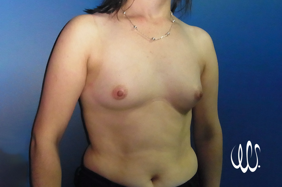 Breast-implants-before