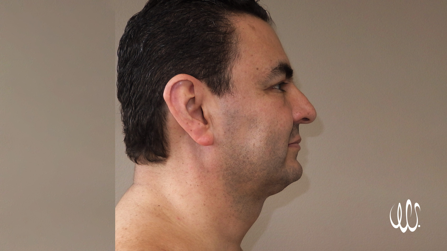 Chin Laser Lipo - After