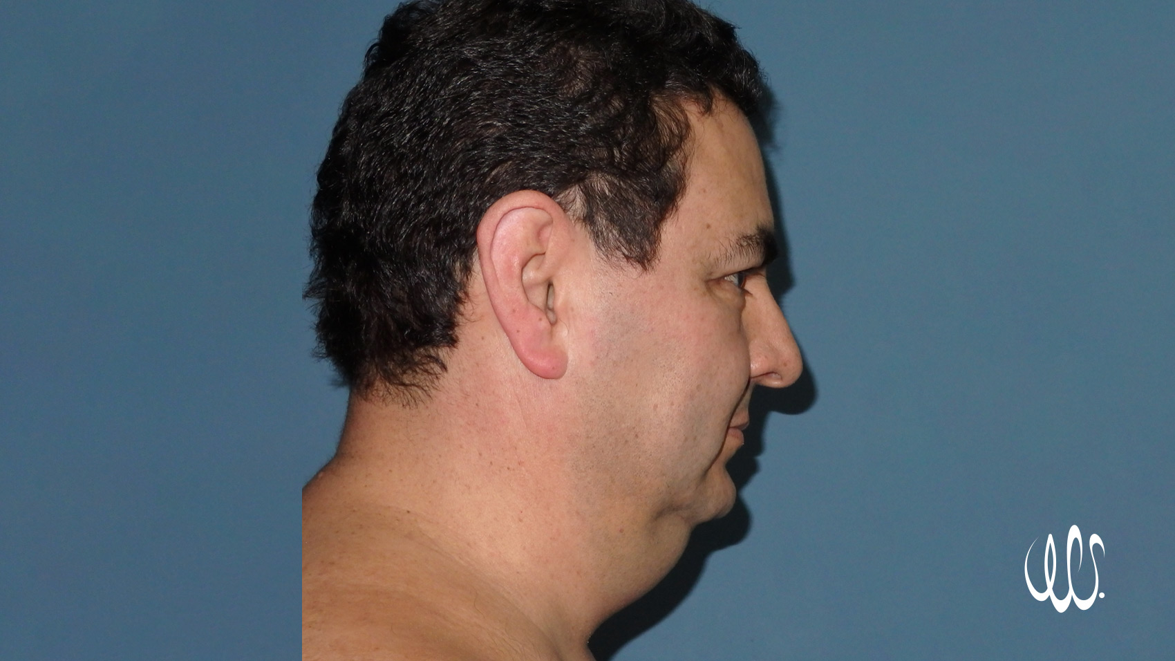 Chin Laser Lipo - Before