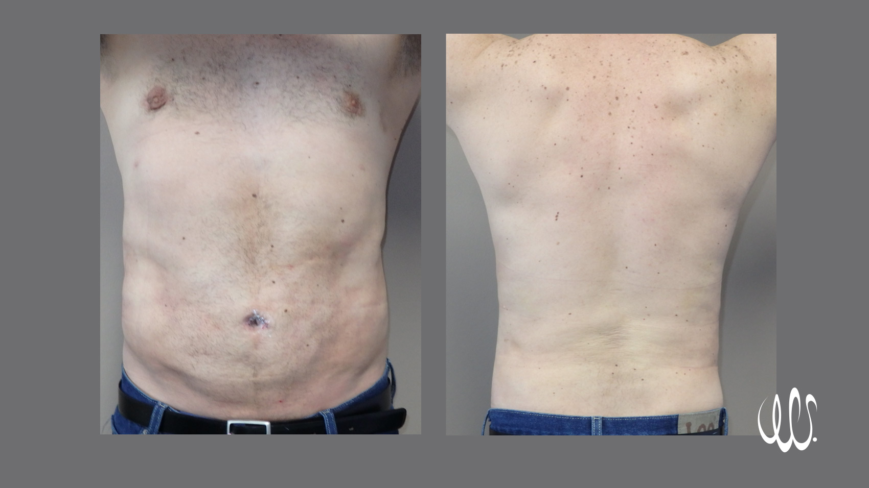 Laser Lipo 360 Before