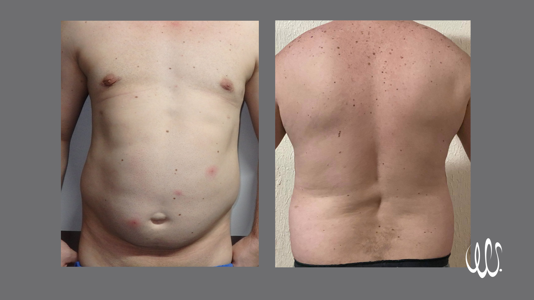 Laser Lipo 360 Before